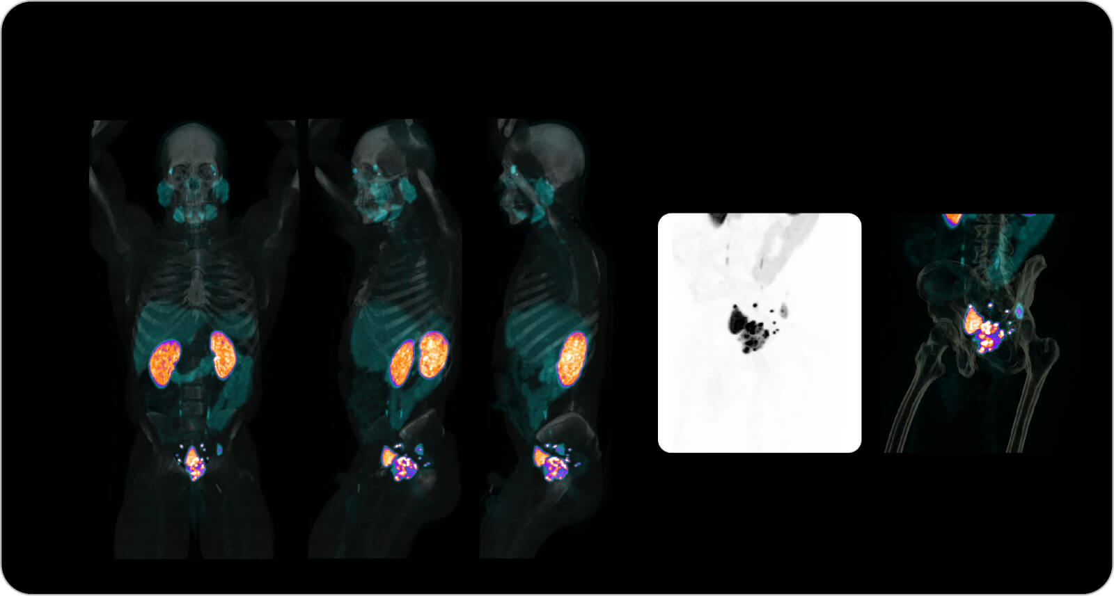 Whole-body PET/CT molecular imaging scans shown in front and side views.