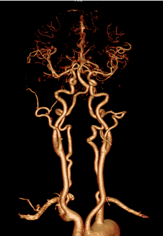Carotid Arteries and Circle of Willis Study