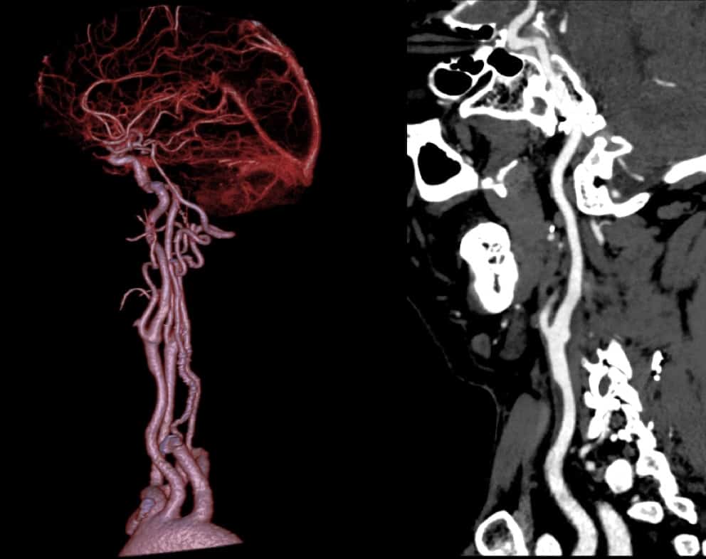Carotid Stenosis and Soft Plaque