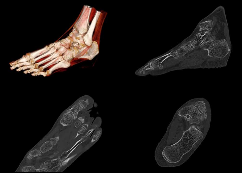 Cortical and Trabecular Bone