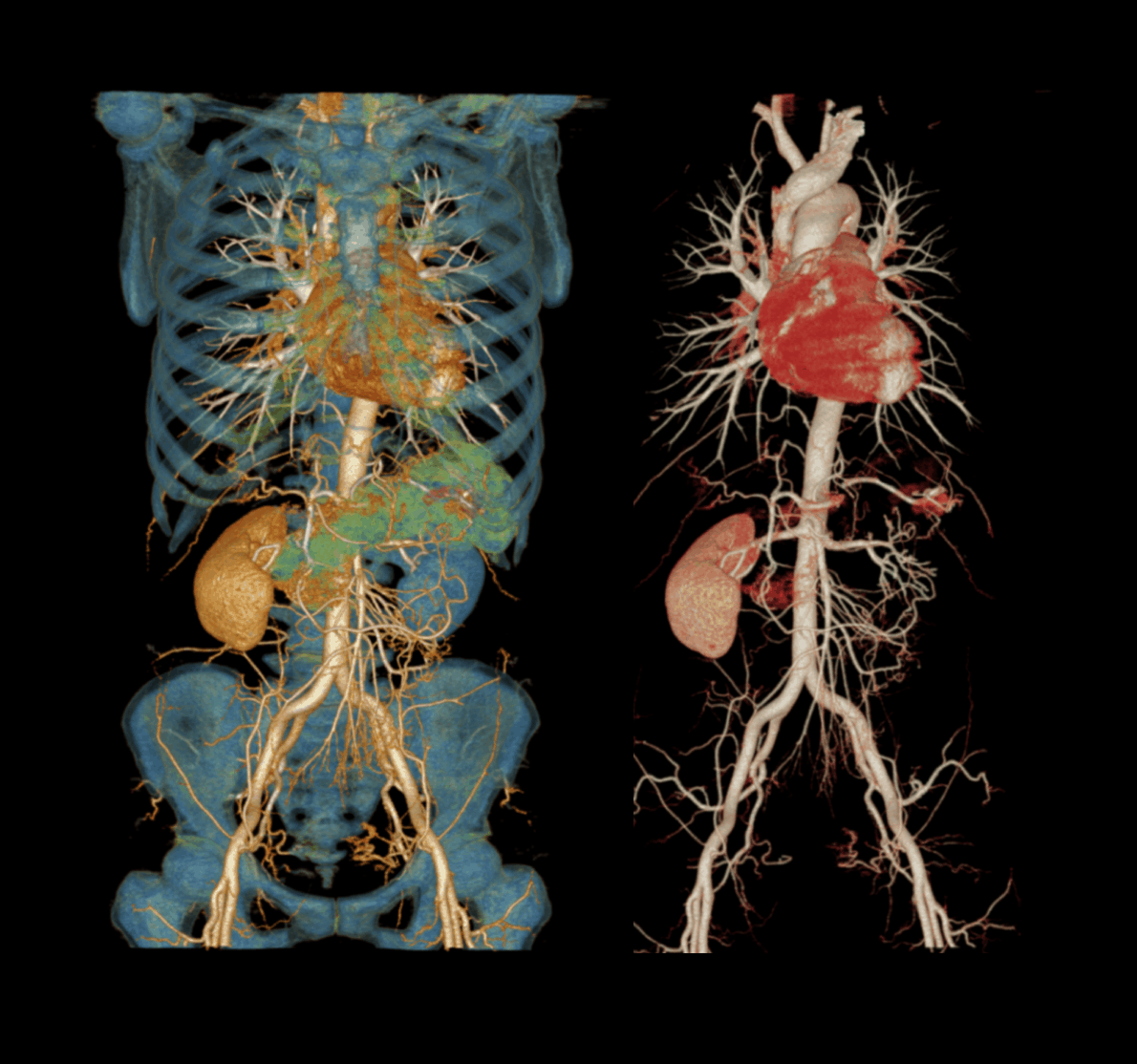 CTA of the Chest, Abdomen and Pelvis