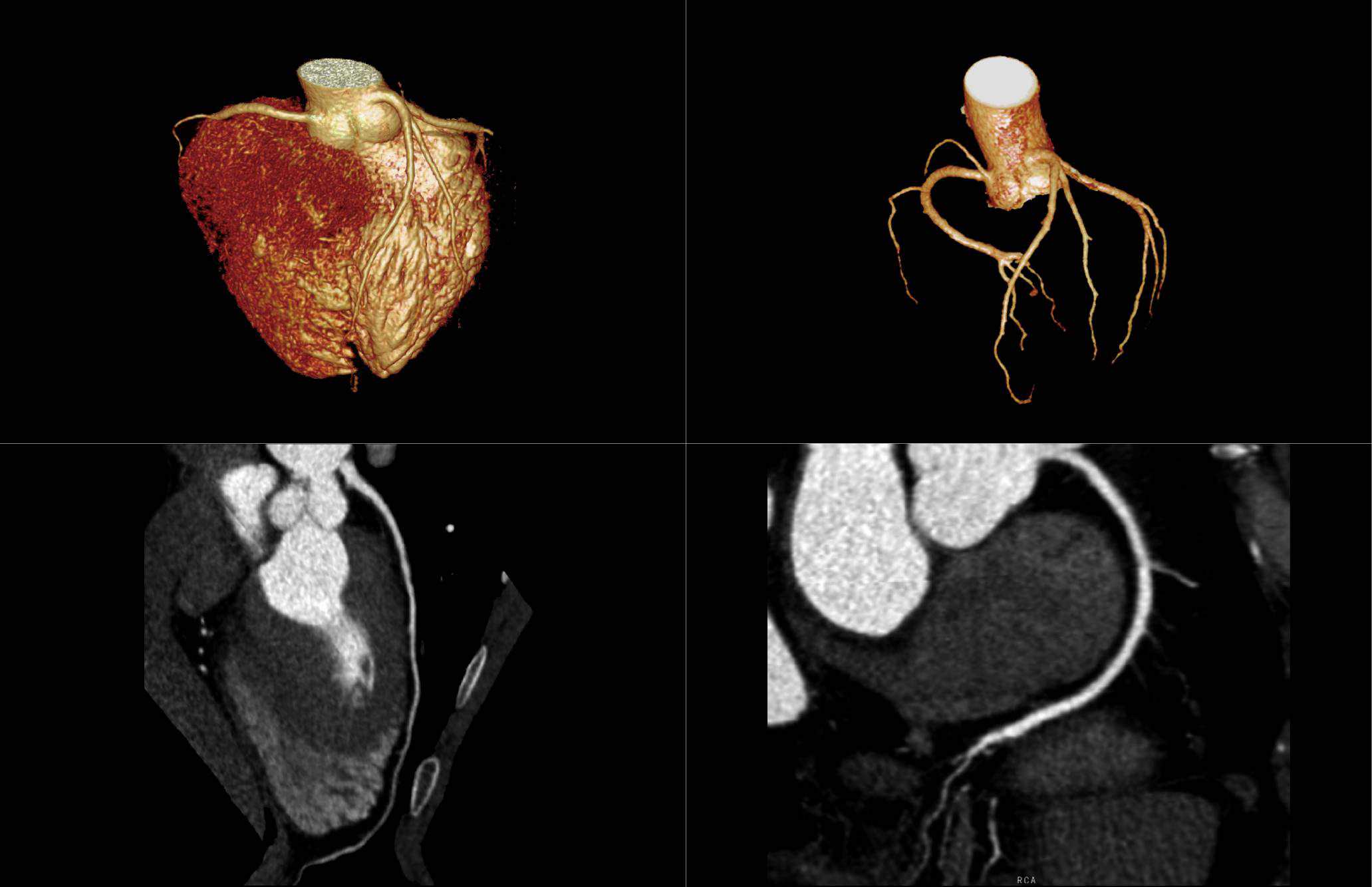 Low Dose - CCTA-80 kV Prospective Scan 0.9 mSv