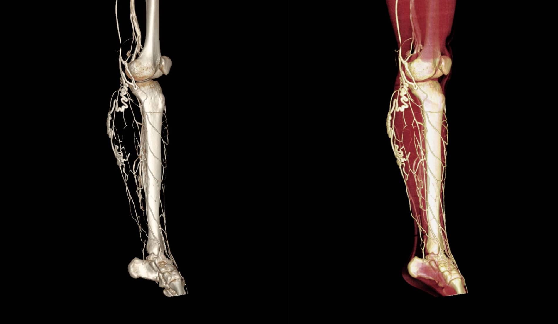 Lower Extremity CTA