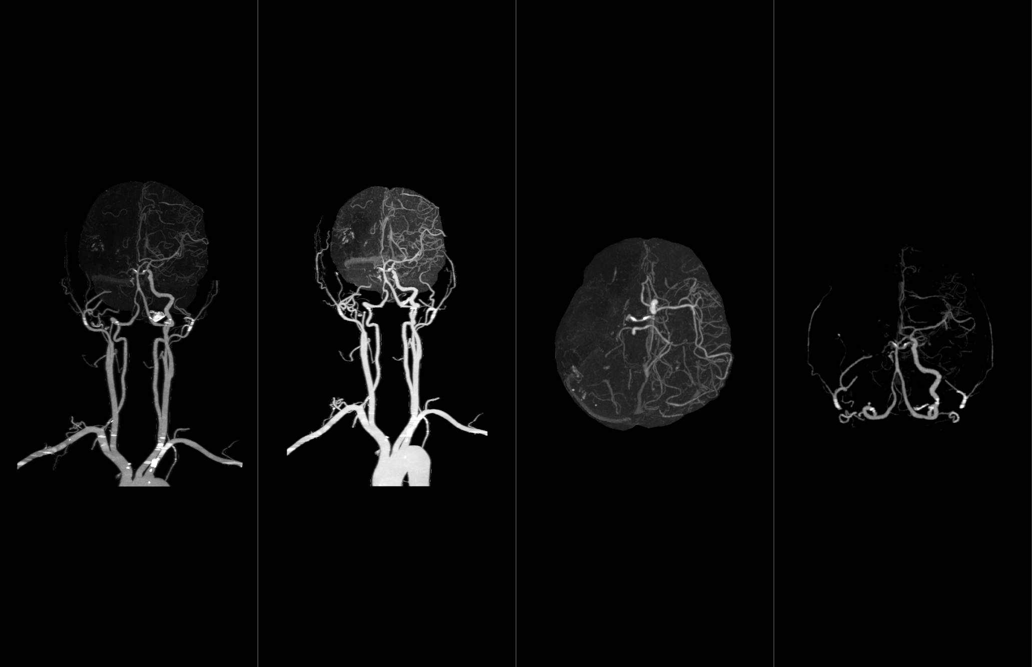 Routine - Cerebral Infarction 