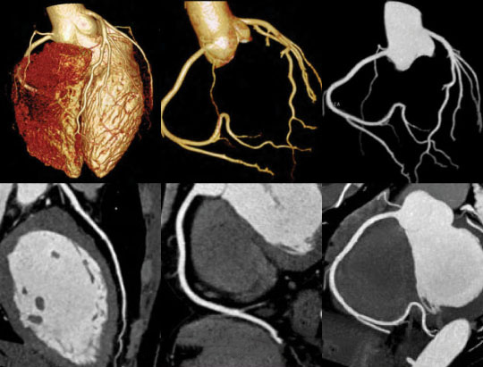 Low dose cardiac clinical image​ acquired on United Imaging CT​