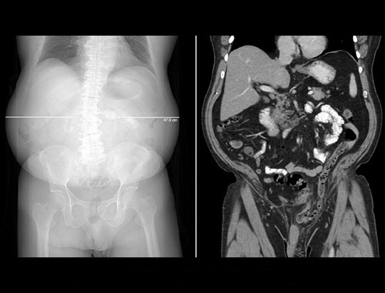 Bariatric abdomen and ​ pelvis exam acquired on United Imaging CT​