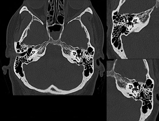 Inner ear CT image ​ acquire on United Imaging CT​