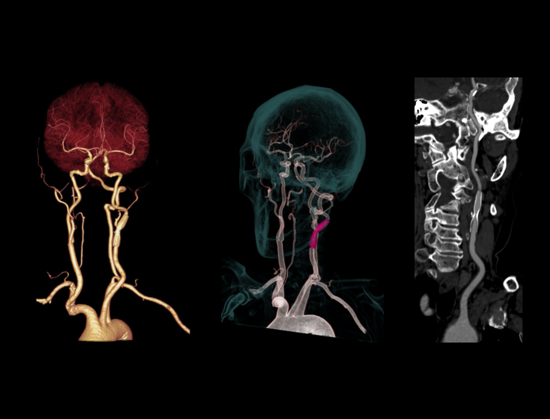 Carotid CTA clinical image ​ acquired on United Imaging CT​