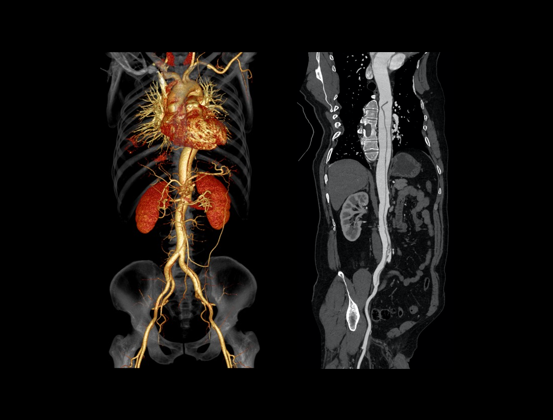 Aortic dissection clinical image ​ acquired on United Imaging CT​