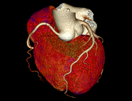 One-Beat Cardiac Scan* Severe Arrhythmia 50-215 bpm