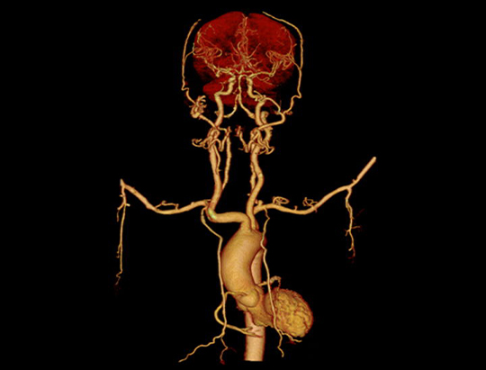 One-Beat Cardiac Scan Combined with Fast Helical CTA Scan*