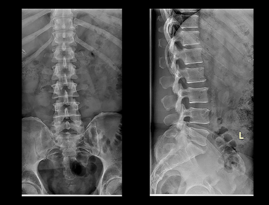 L-Spine