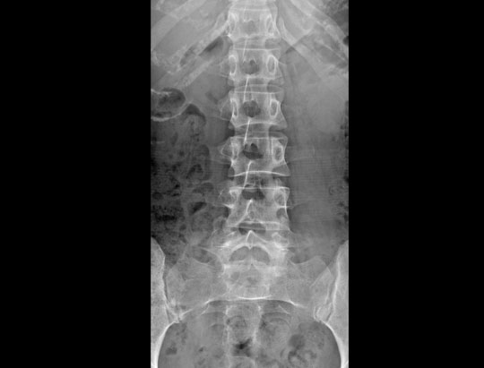 Clinical Image of a Lateral Lumbar Spine