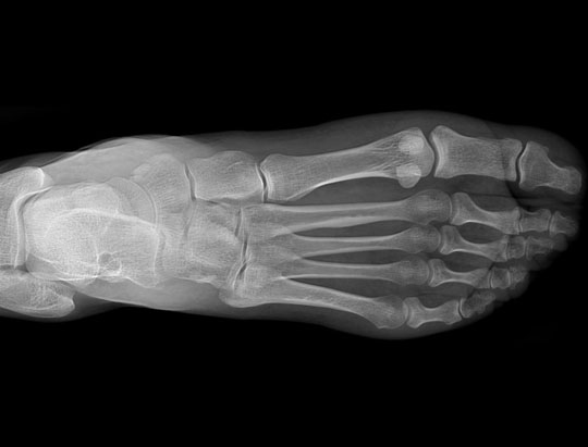 Clinical Image a Foot AP