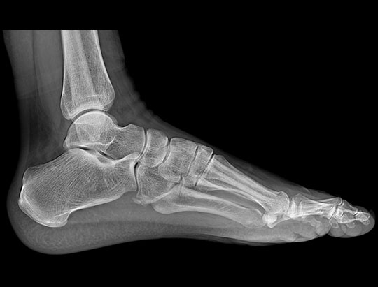 Clinical Image of a Lateral Foot
