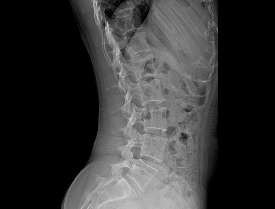 Clinical Image of a Lateral Lumbar Spine