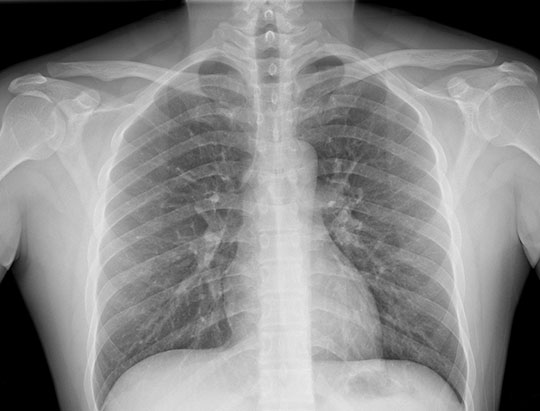 Clinical Image of a PA Chest