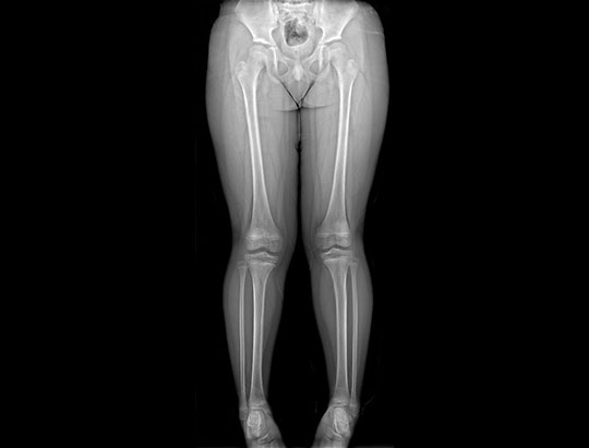 Hip to ankle X-ray image 
