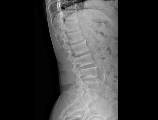 Lateral Lumbar Spine X-ray image