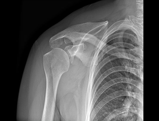 AP Shoulder X-ray Image