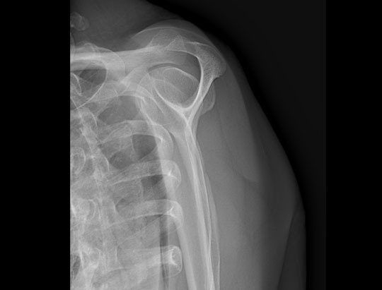 Y-View Shoulder X-ray Image