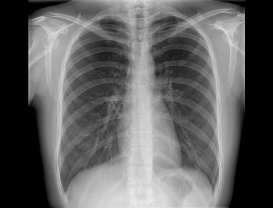 chest x-ray in lateral position
