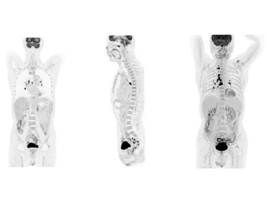 Lesion Detectability for PET