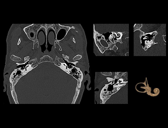 Ossicles and Inner Ear