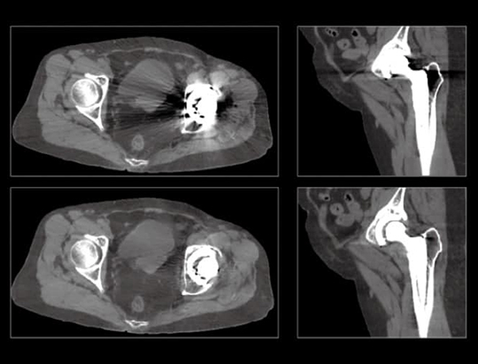 Metal Artifact Correction