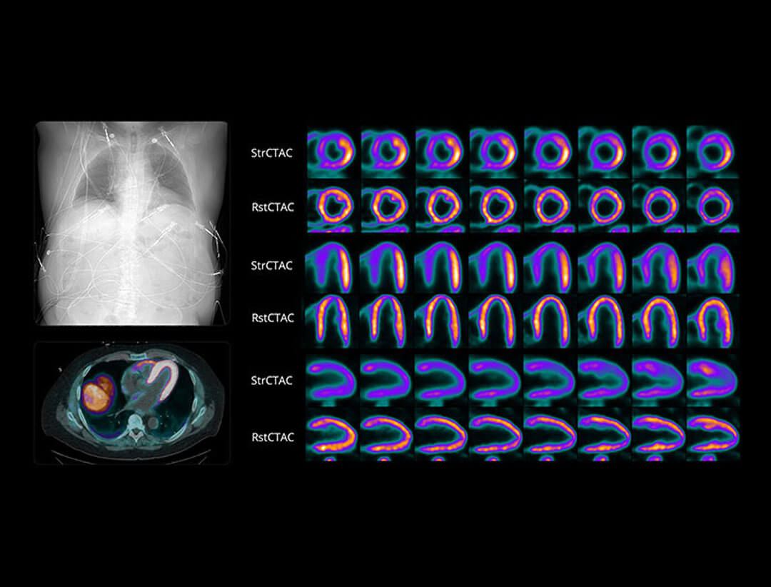 Stress and rest 18F-flurpiridaz myocardial perfusion images demonstrating 189 ps TOF imaging in an obese patient with coronary artery disease.
