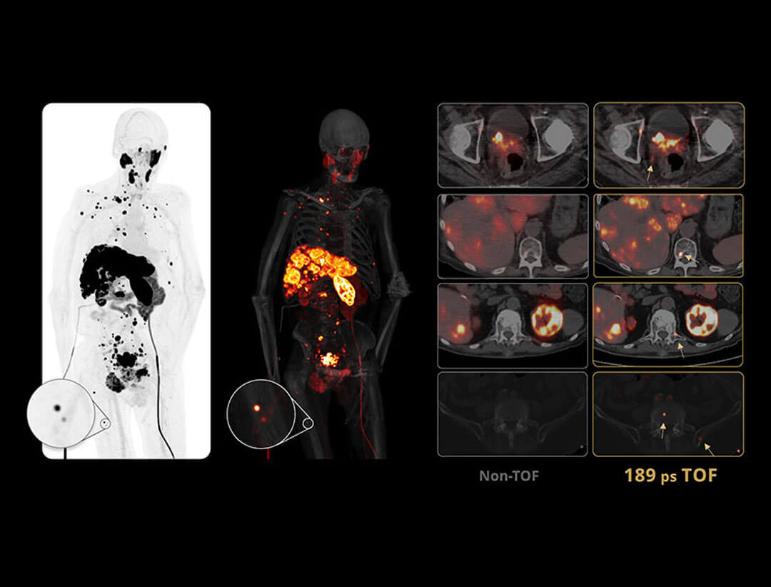 Whole-body 18F-PSMA PET images comparing non-TOF and 189 ps TOF reconstruction for detecting prostate cancer metastases