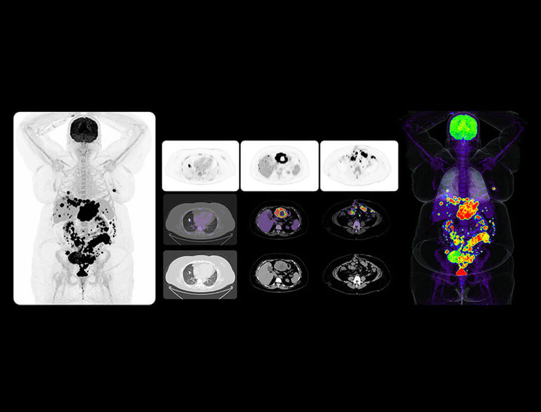 Whole-body and cross-sectional 18F-FDG PET/CT images showing sub-centimeter peritoneal tumor seedings in a patient with BMI 46.