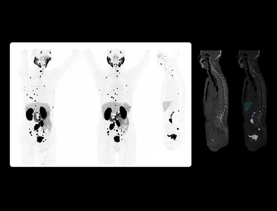 Whole-body 68Ga-PSMA PET/CT images showing widespread metastatic prostate cancer lesions.