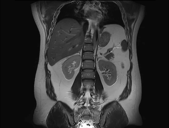 MRI of an Abdomen with a large field of view