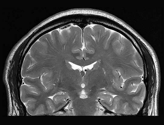 MRI of the Brain with Artificial Intelligence