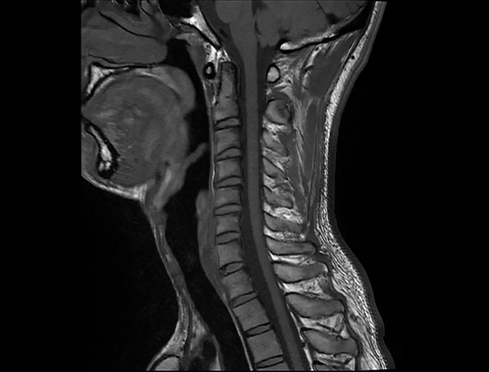 MRI of a neck T1 weighted