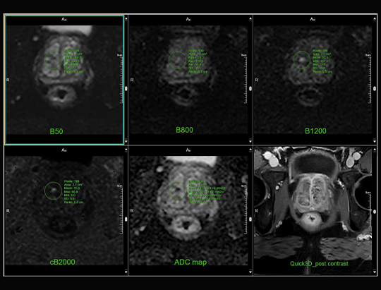MRI of a prostate with analysis