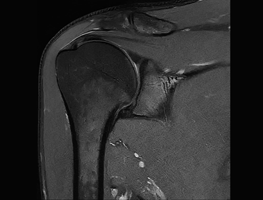 MRI proton density shoulder