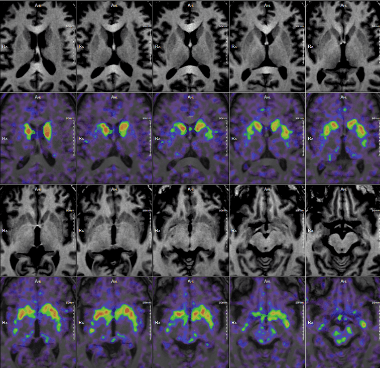 PET/MRI of the Brain with Parkinson’s