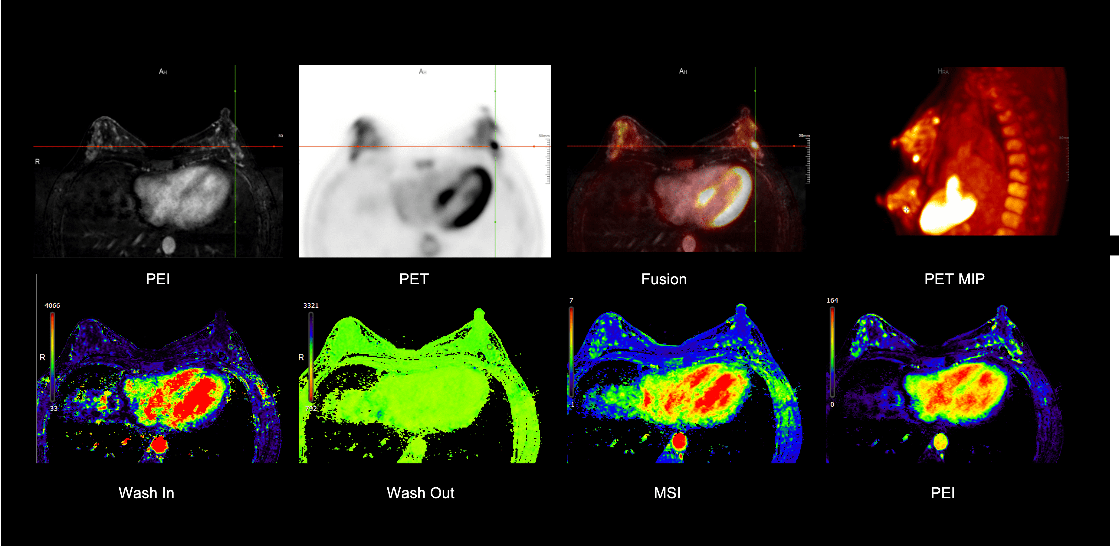 PET/MRI of the Breast  with a Lesion