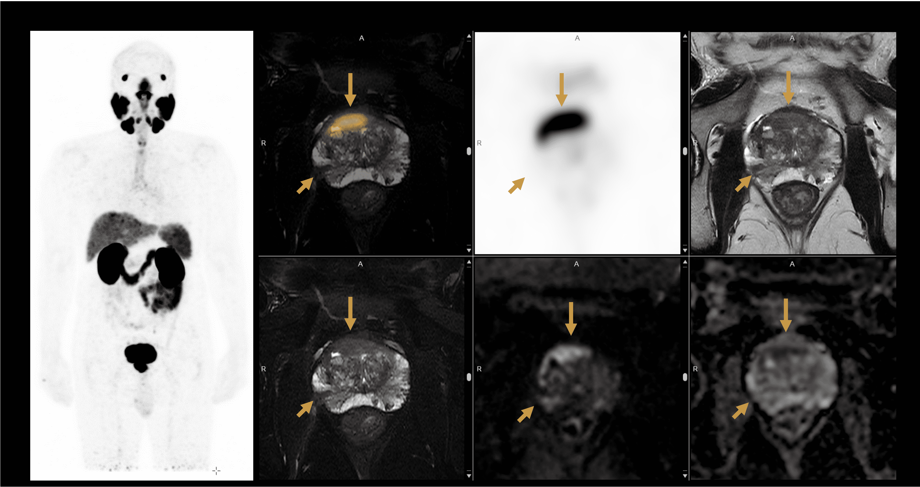 PET/MRI of the Prostate  with a Lesion