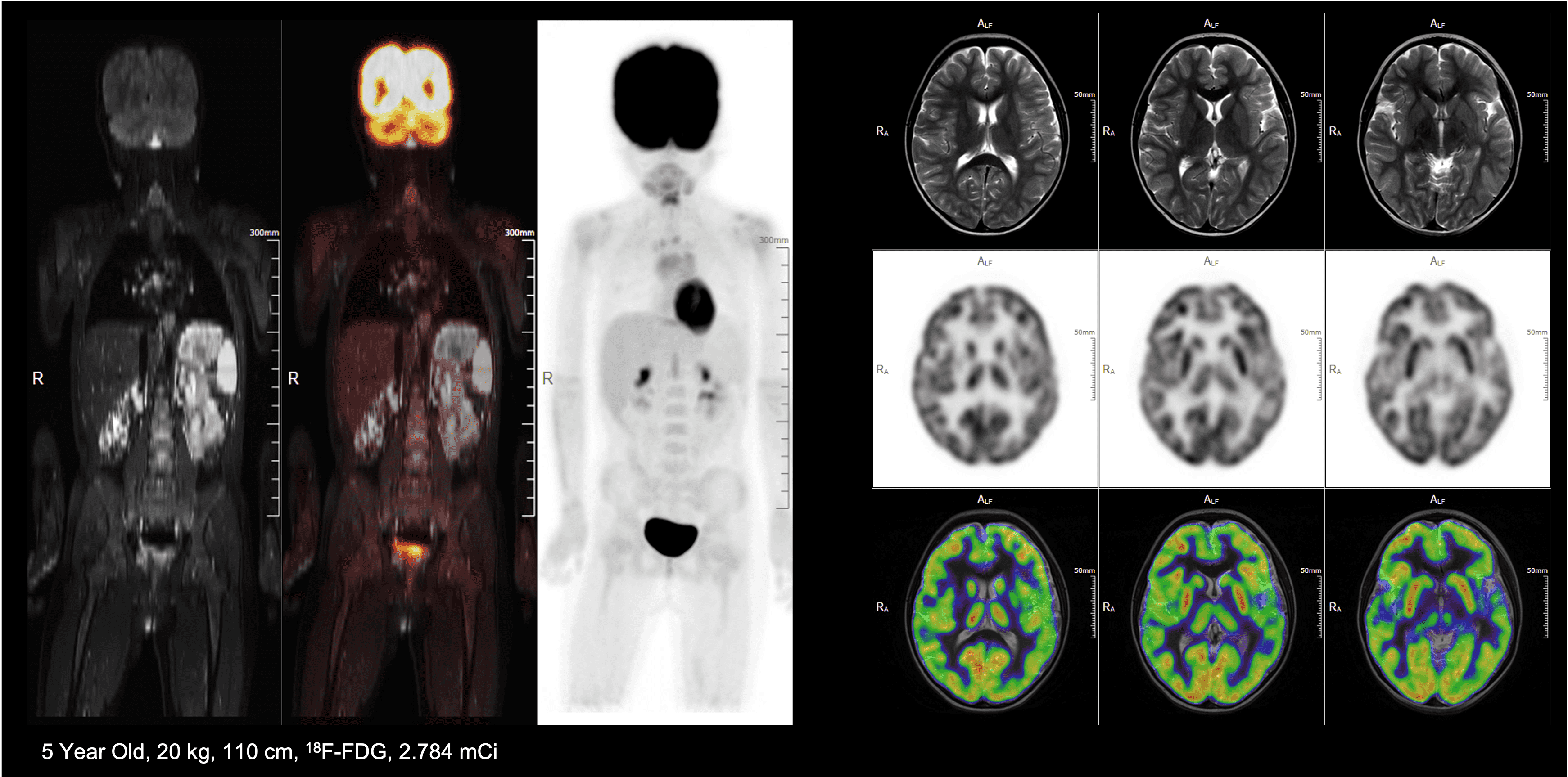 PET/MRI of a pediatric patient with lymphoma